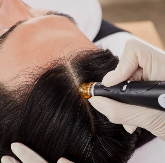Hair Regrow treatment by HF KERAVIVE